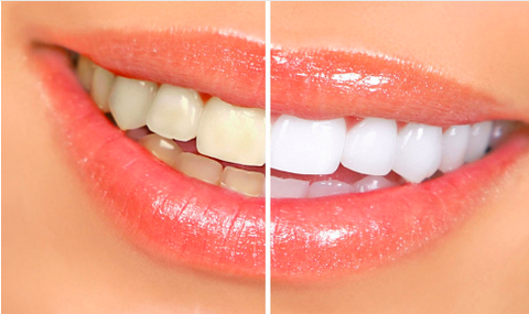 Image of Natural activated charcoal teeth whitening